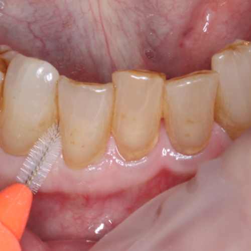 En mellemrumstandbørste.